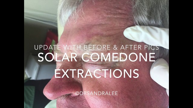 Extracting Large whiteheads around the eyes An Update with before & after pics