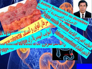Cancer du côlon et du rectum - Lésions festonnées    سرطان القولون و المستقيم :الاصابات المسننة أو الفيستونية