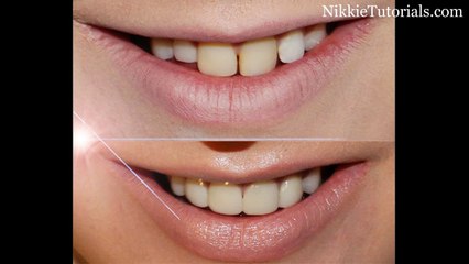 My New Teeth! - What really happened?