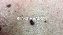 A big blackhead and some seborrheic keratoses treated on the back