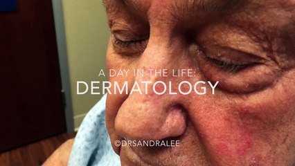 A Day in Dermatology  Various dermatologic procedures including extractions