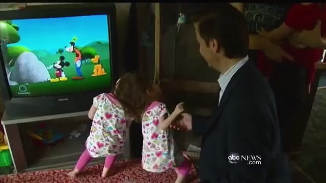 Conjoined Twins- Twin Girls, A Medical Wonder Amzing Videos