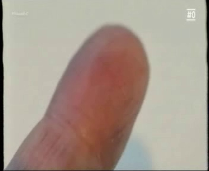 Adermatolglifia: Nacer sin huellas dactilares