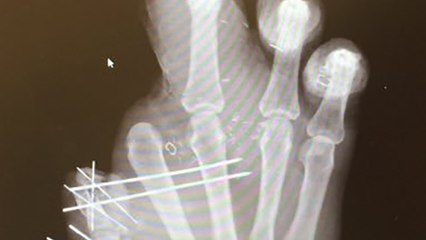 Jason Pierre-Paul Shares X-Ray of His Hand