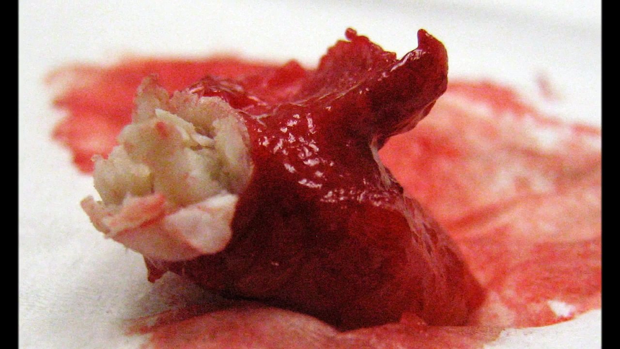 Sebaceous Cyst Removal From Skull; Pilar Cyst Excised