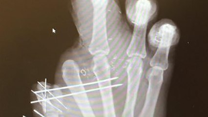 Jason Pierre-Paul Shares X-Ray of His Hand