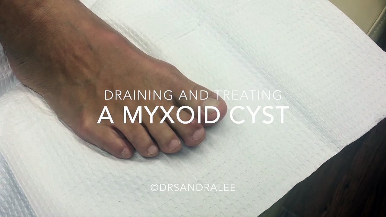 Draining & treating a Myxoid Cyst