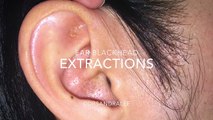 Ear Extractions