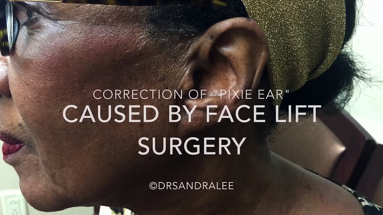 Earlobe repair  Fixing  pixie ear  created after a face lift procedure