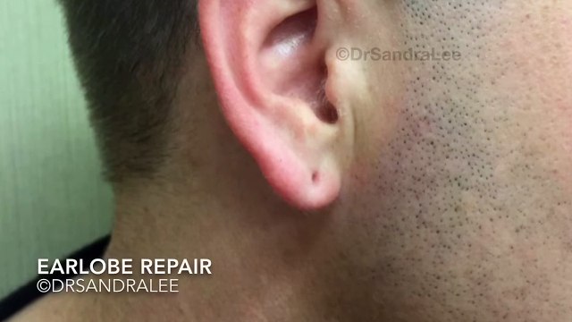 Earlobe repair from plugs that dilated pierced holes. For medical education- NSFE.