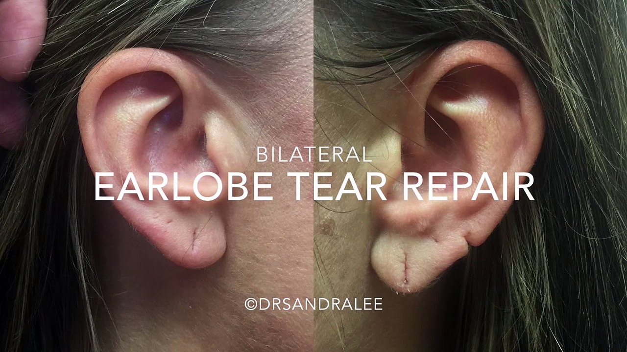 Earlobe Tear Repair