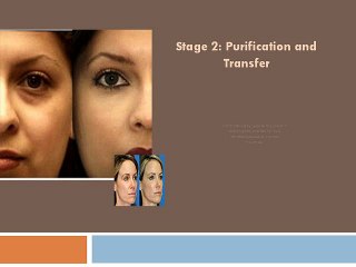 Fat Grafting Procedure and its Advantages
