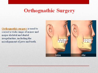 orthognathic surgery and its types