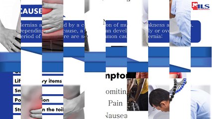 Hernia Treatment in Kolkata by ILS Hospitals