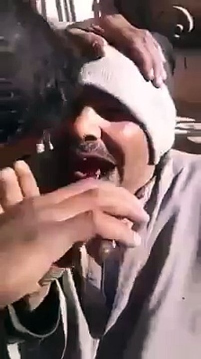 قلع السن بدون بنج