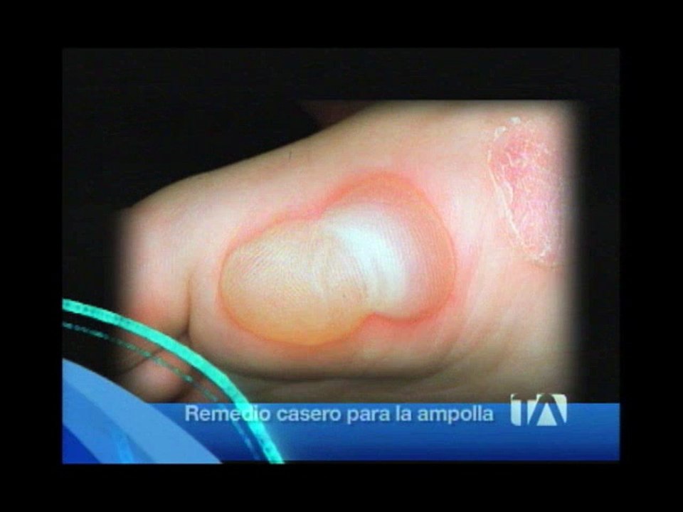 Cómo curar las ampollas