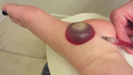 BIG wart blister after freezing with liquid nitrogen