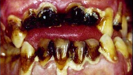 Drugs abuse: faces before and after; addicted condition