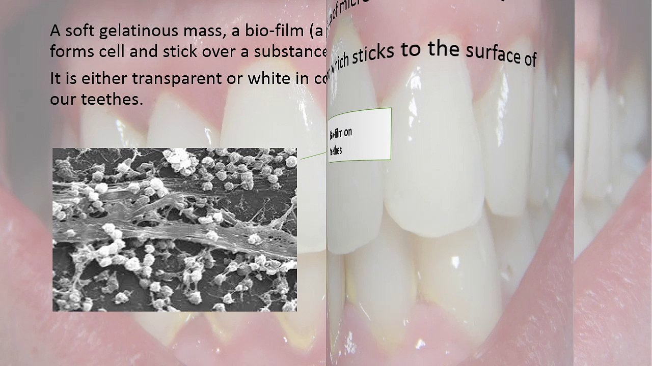 Dental Plaque: Explained