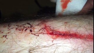Sliced My Shin Down To BONE & Kept Skating_! (GRAPHIC) _ My Worst Skateboarding Shinner EVER