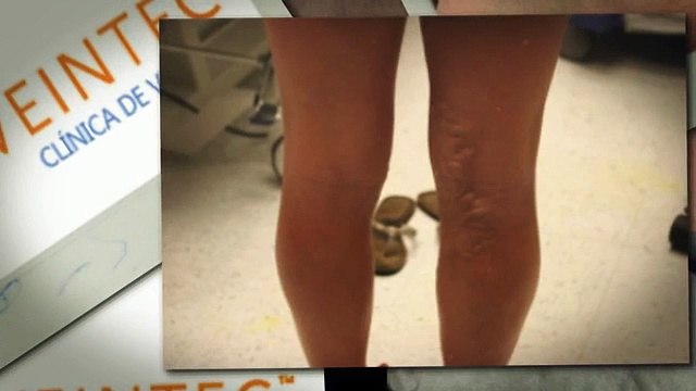 Mejor cirugía de la vena Laser Clinic en Cd. Obregón