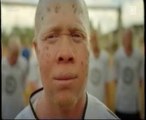 Albino United: Melanocitos y color de la piel