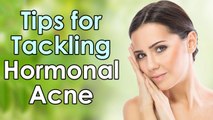 5 Tips for Tackling Hormonal Acne || Beauty Tips
