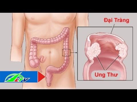 Dấu hiệu nhận biết sớm ung thư đại trực tràng | LTV