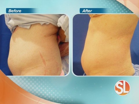 EnteBella offers non-surgical body contouring