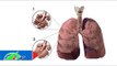 Xơ phổi: Căn bệnh không thuốc chữa | LTV