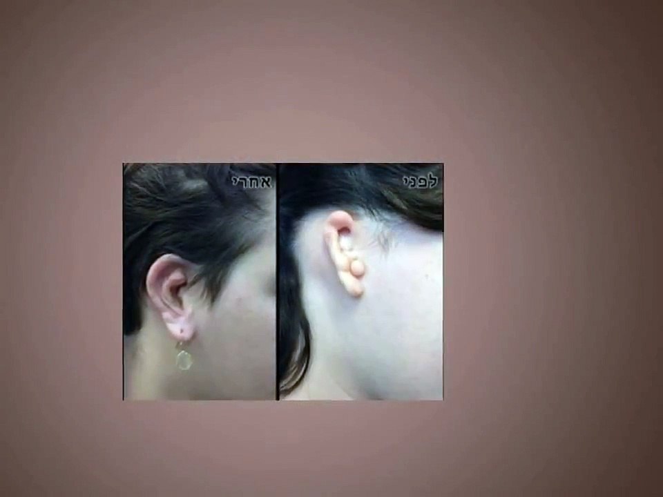 עמי ברק - כל מה שצריך לדעת על שחזור אוזניים