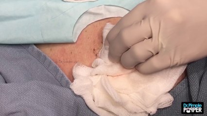 La docteur découvre une énorme bosse dans son dos, ce qu'il y à l'intérieur, OH MY GOD!