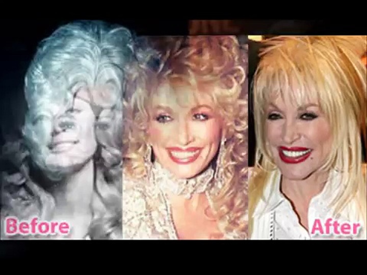 ⁣Dolly Parton: Before and After Plastic Surgery