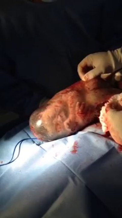 Un bébé est né dans son sac amniotique - Vidéo Dailymotion
