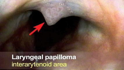Understanding Laryngeal Papilloma: Causes, Symptoms, & Treatment Options 🩺