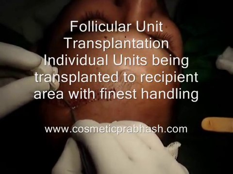 Hair Transplant Fue Delhi India Dr. Prabhash's Clinic