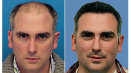 Hair Transplant Mind blowing results