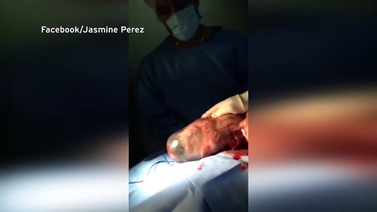 Le bébé néé dans son sac amniotique