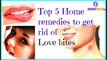 Tips-Top 5 Home remedies to get rid of Love bites
