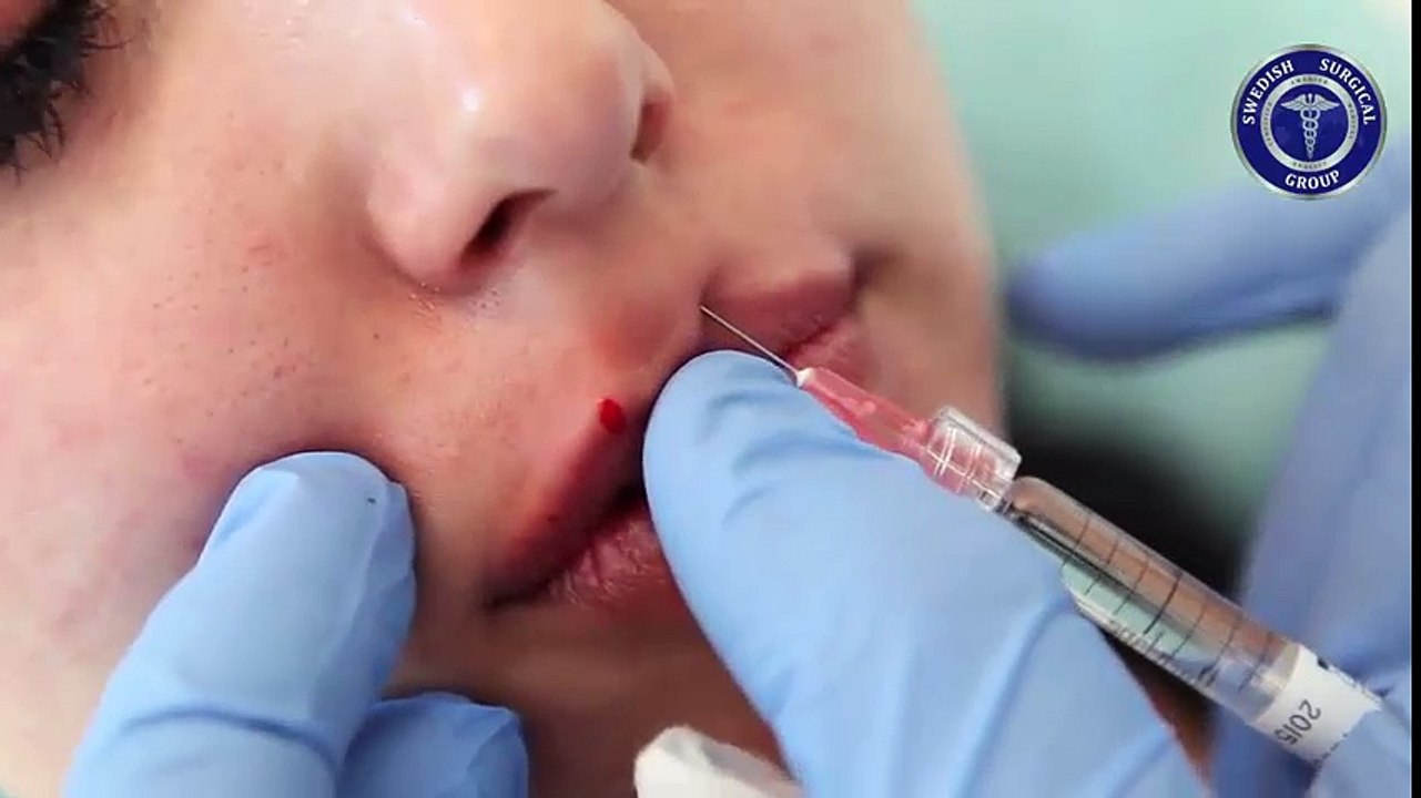 Close-up of cases by an injection pump lip fillers