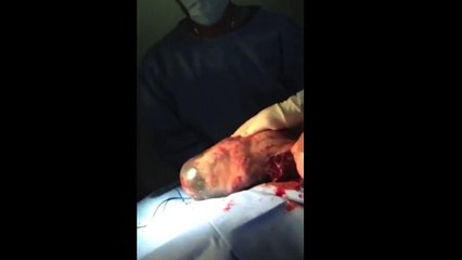 Un bébé né dans son sac amniotique intact ! WTF !