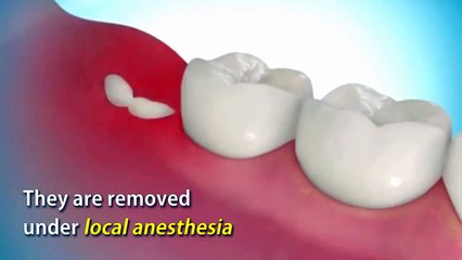 Wisdom Tooth Removal - Health Care