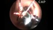 Girls ear infested with giant ants nest horrifies doctors in stomach churning video