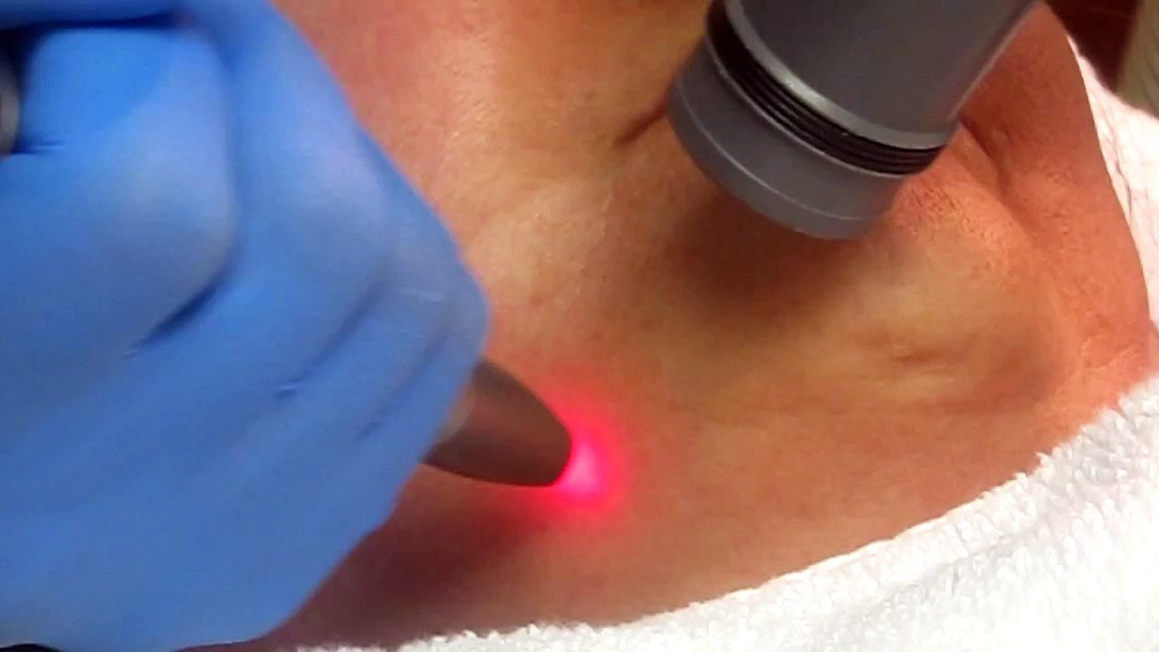 Skin Resurfacing-Los Angeles-Anaheim-Burbank-Fullerton-Pasadena-Covina-Glendora-Diamond Bar