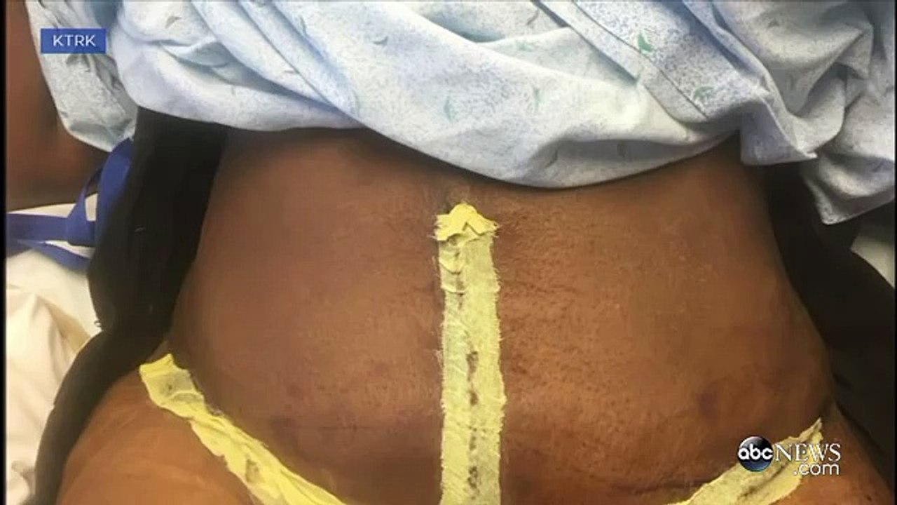 Houston Woman Wakes Up WITHOUT A Belly Button After Tummy Tuck Surgery