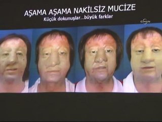 Nakilsiz yüz yapımı ameliyatı ile yeni yüzüne kavuştu