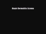 Download Atopic Dermatitis: Eczema Free Books