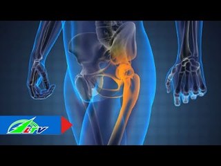 Phòng và điều trị thoái hóa khớp háng | LTV