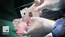 Surgeons replace bone with 3D-printed vertebrae to save cancer patient's life