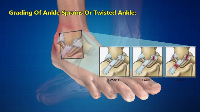 Ankle Sprain Or Twisted Ankle